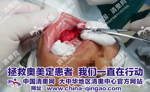 奥美定取出