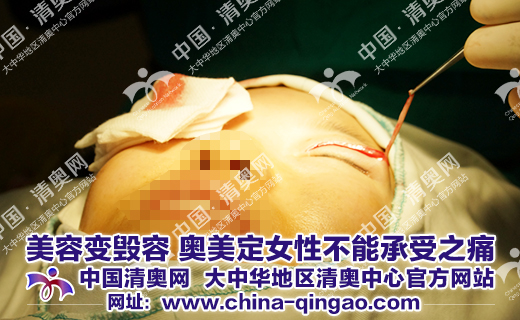 奥美定取出后遗症